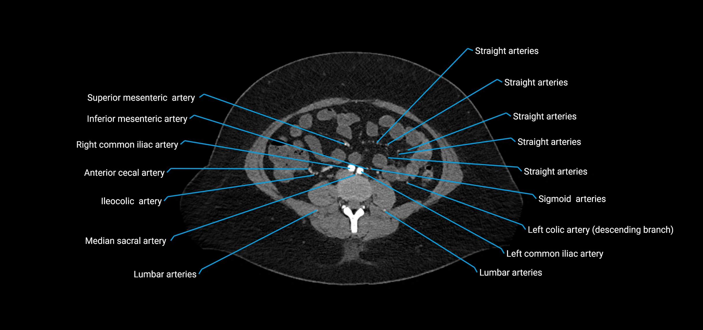 CTA abdomen axial cross sectional anatomy labelled image_128 (2).webp